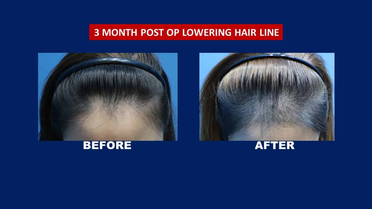 Female Hair Transplant- See Before after Results - Proven Female Hair Transplant- See Before after Results - Proven