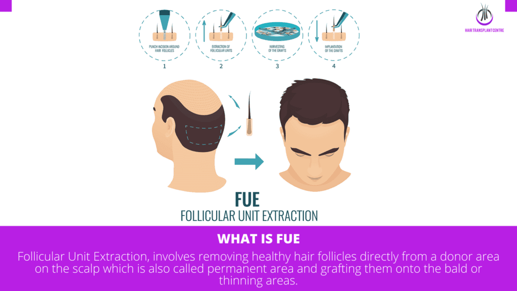 FUE Hair Transplant Solutions