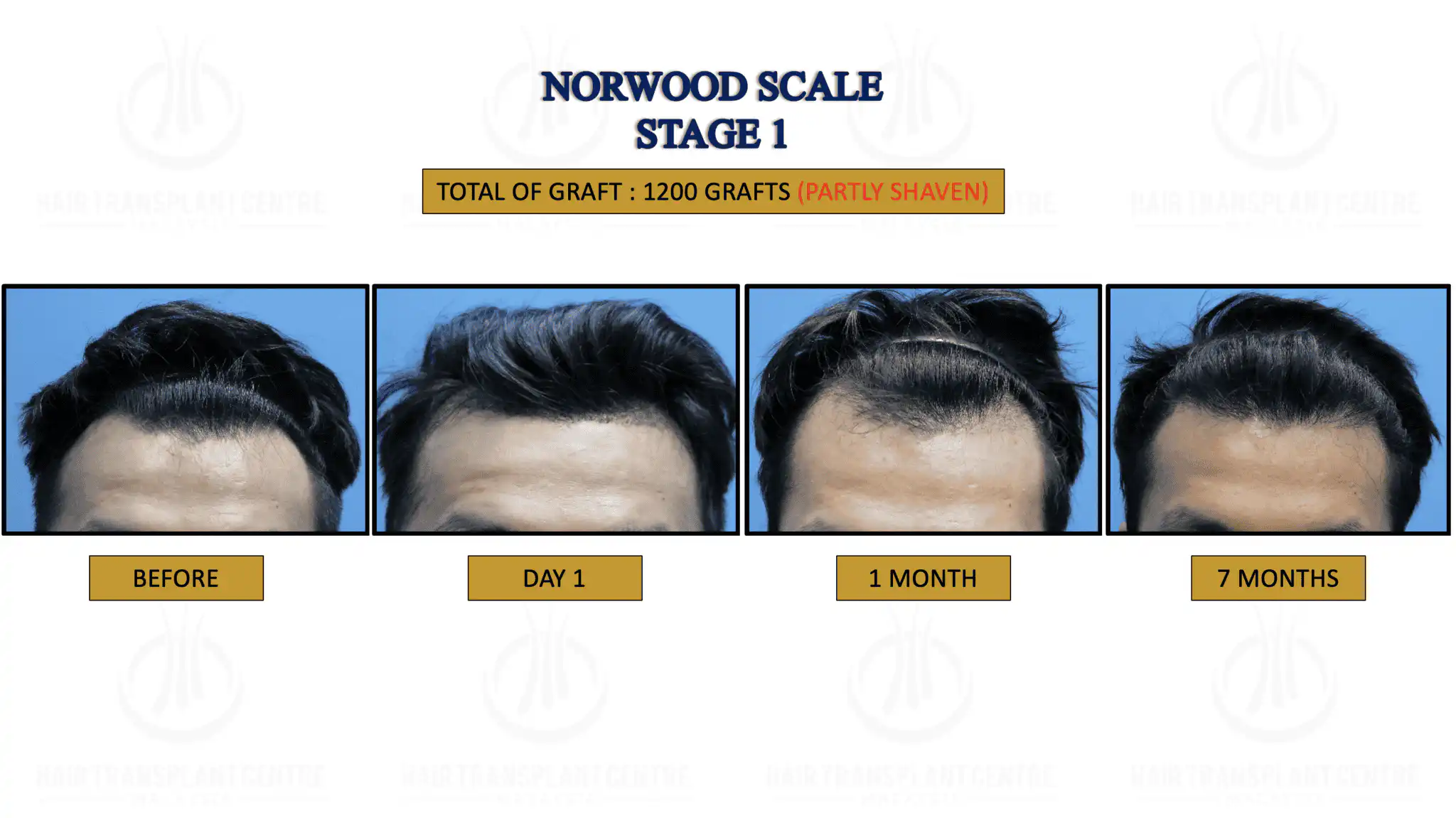 NORWOOD STAGE 1