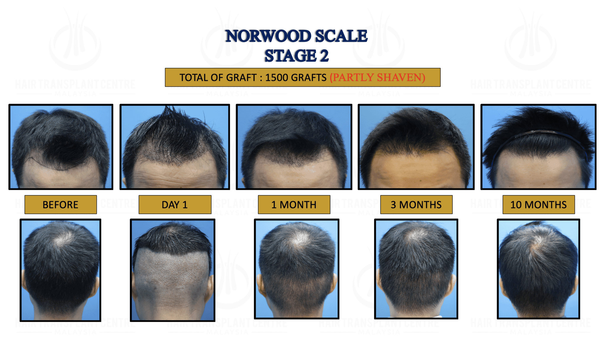 Norwood Stage 2 Hair Transplant Centre Malaysia Hair Treatment