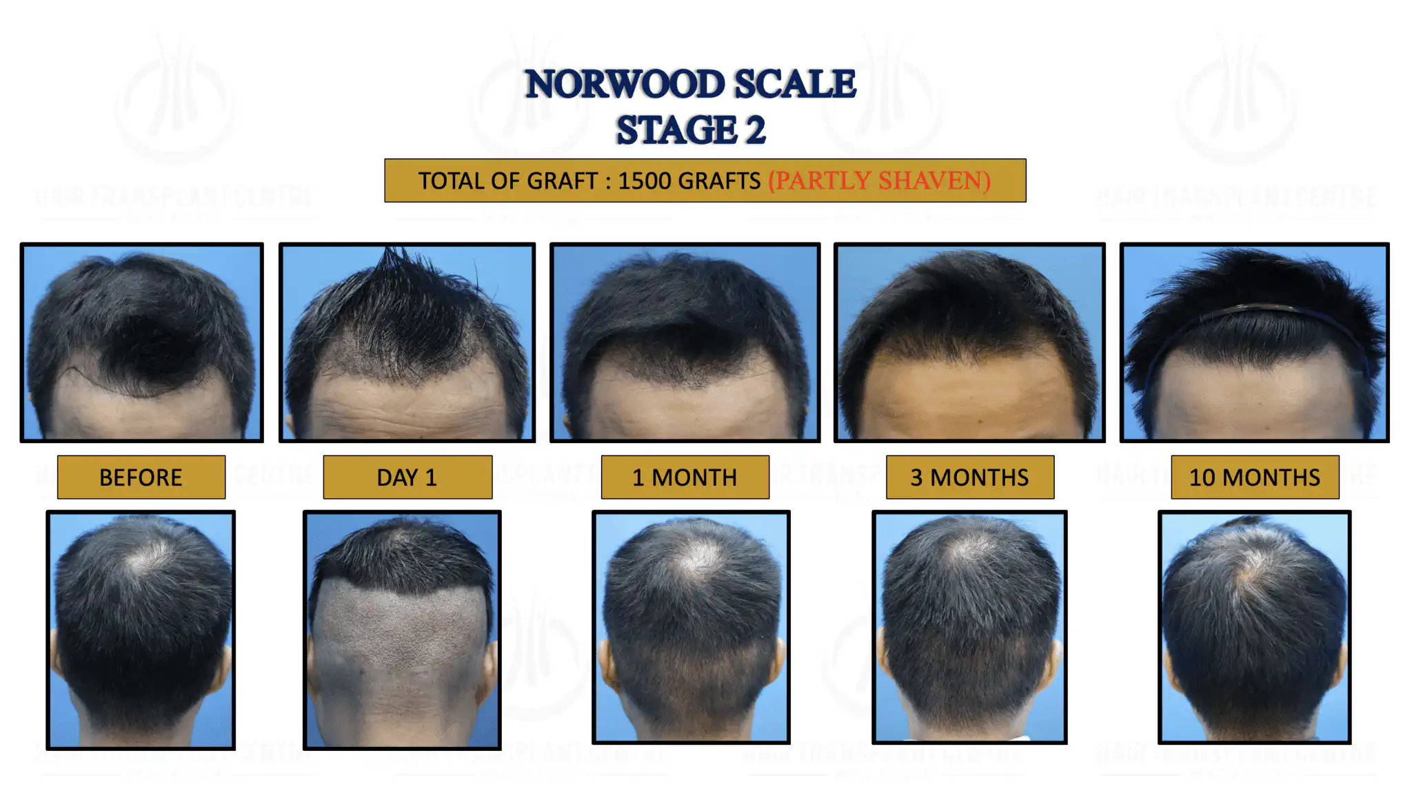 2. NORWOOD SCALE STAGE 2