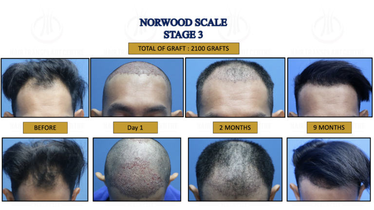 Norwood Stage 3 - Hair Transplant Centre - Malaysia Hair Treatment