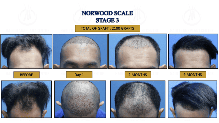 Norwood Stage 3 - Hair Transplant Centre - Malaysia Hair Treatment Norwood Stage 3 - Hair Transplant Centre - Malaysia Hair Treatment