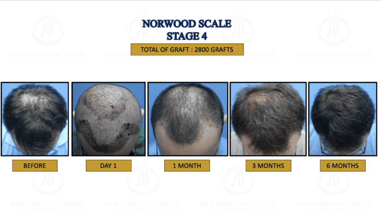Norwood Stage 4- Hair Transplant Centre - Malaysia Hair Treatment Norwood Stage 4- Hair Transplant Centre - Malaysia Hair Treatment