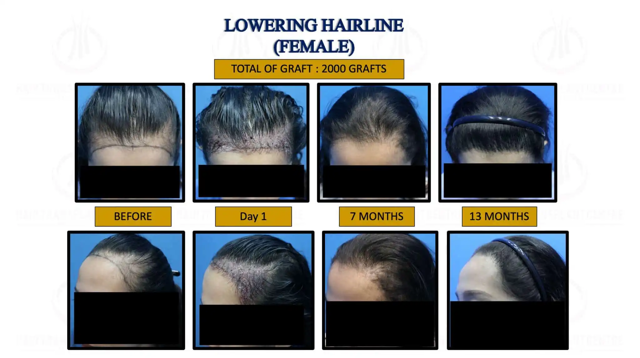 LOWERING HAIRLINE ( FEMALE ) 2