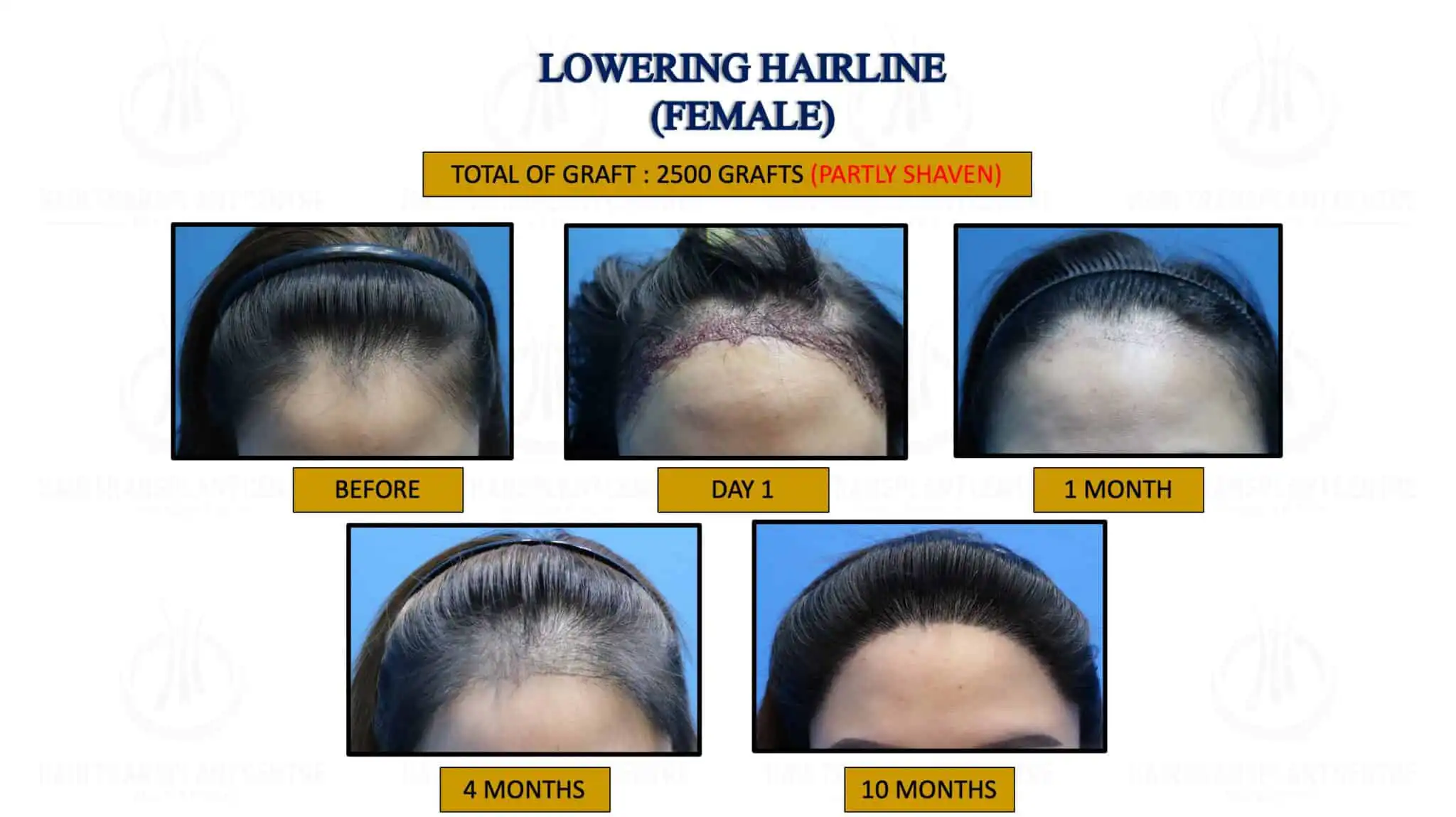 LOWERING HAIRLINE ( FEMALE ) 3