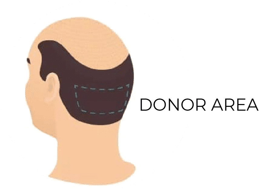Hair Transplant Centre Donor Area