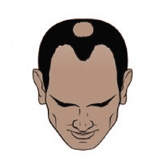 Norwood 4 Hair Transplant