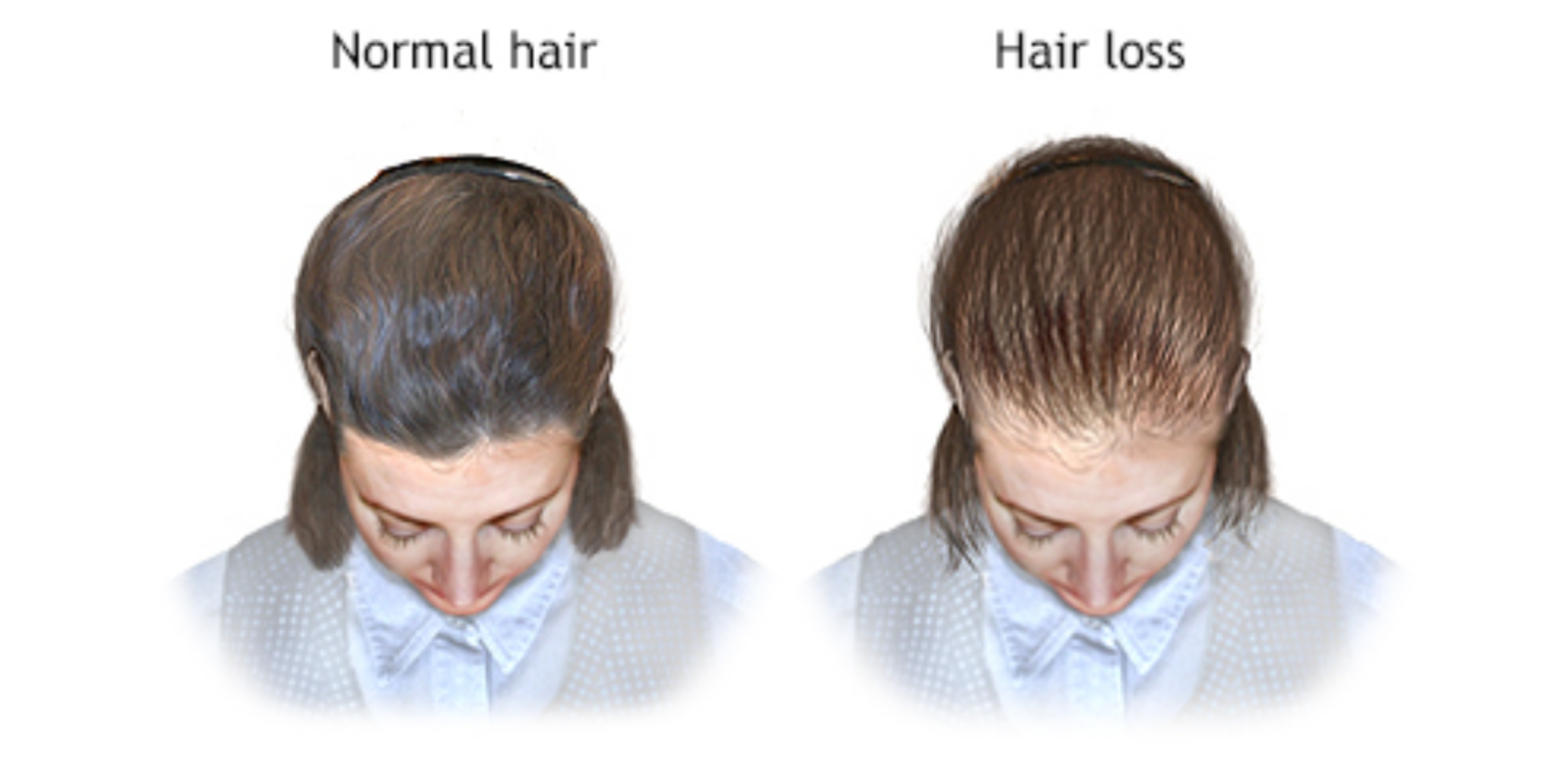 Каждый день выпадают волосы. Нормальное выпадение волос. Сколько волос выпадает в день.
