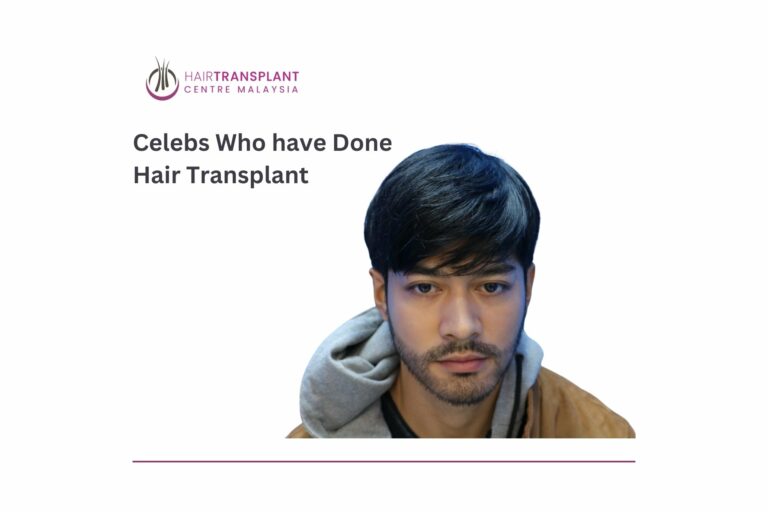 Celebs Who have Done Hair Transplant