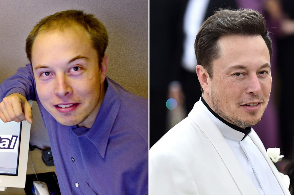 Elon mask hair transplant