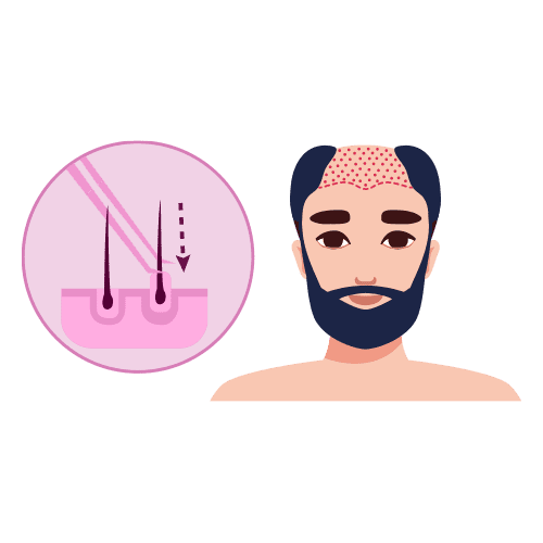 Placing the Follicular Units
