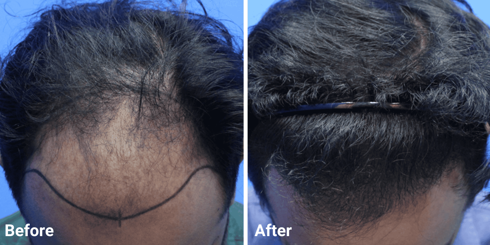 Fue Male Hair Transplant Hair Transplant Centre Malaysia Fue Male Hair Transplant Hair Transplant Centre Malaysia