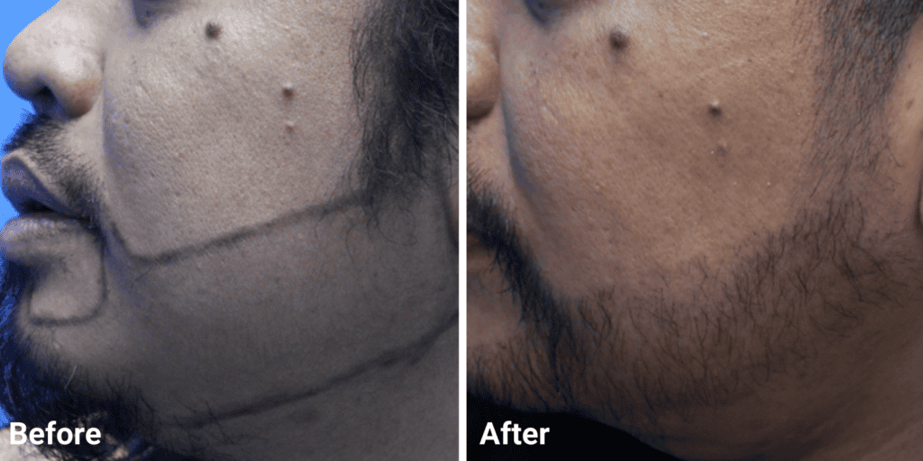 Beard Transplant