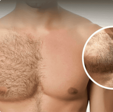 BODY HAIR TRANSPLANT