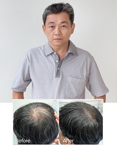 Hair Transplant Malaysia - Best Hair Transplant Centre - Proven. Safe