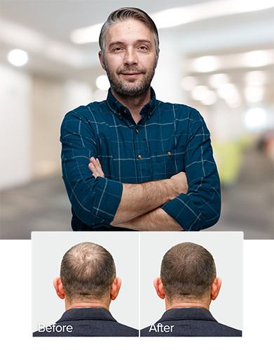 Hair Transplant Malaysia - Best Hair Transplant Centre - Proven. Safe