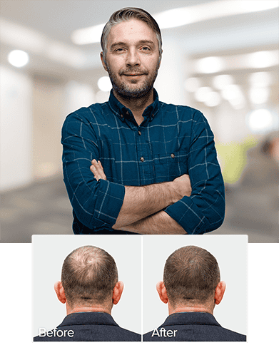 Hair Transplant Malaysia - Best Hair Transplant Centre - Proven. Safe Hair Transplant Malaysia - Best Hair Transplant Centre - Proven. Safe