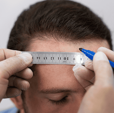 LOWERING HAIR LINE