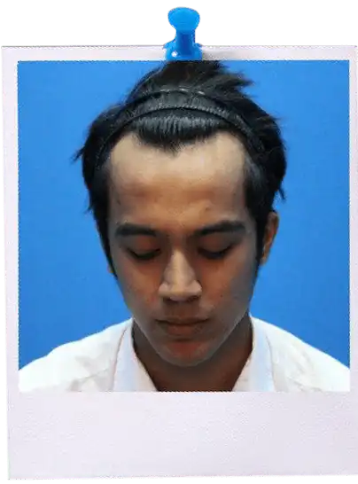 FUE Hair Transplant Malaysia