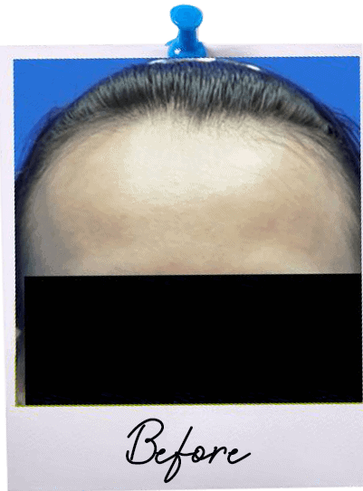 Hair Transplant centre malaysia - Before Hair Transplant image 112
