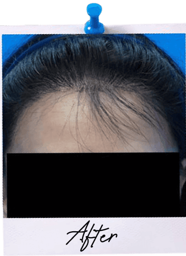 Hair Transplant centre malaysia - After Hair Transplant image 112