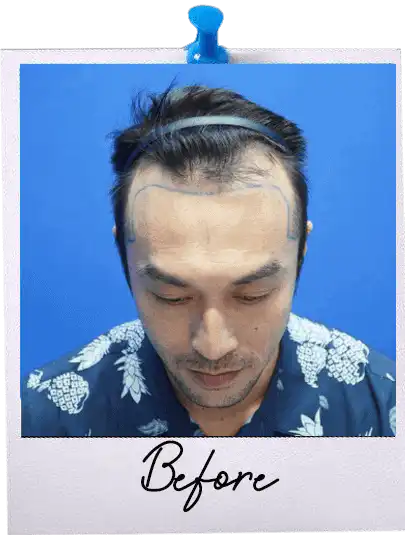 FUE Hair Transplant Malaysia
