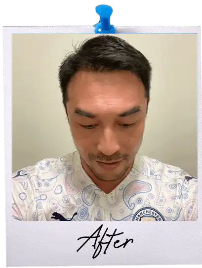 FUE Hair Transplant Malaysia