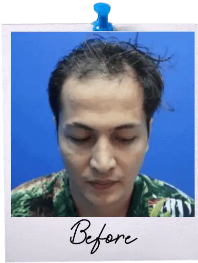 FUE Hair Transplant Malaysia