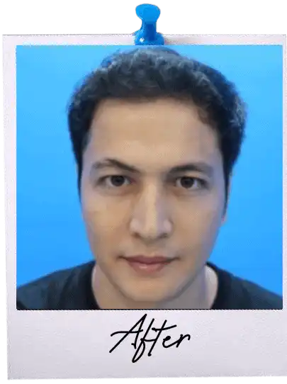 FUE Hair Transplant Malaysia