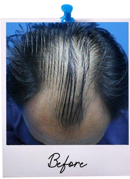 Hair Transplant centre malaysia - Before Hair Transplant image 116