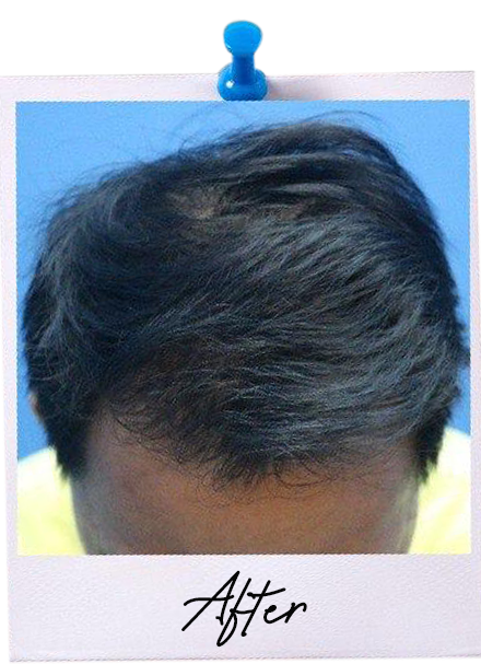Hair Transplant centre malaysia - After Hair Transplant image 116