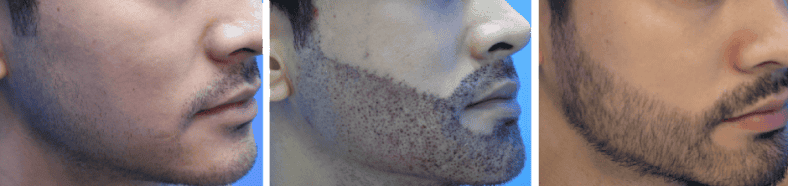 Beard Hair Transplant in Hair Transplant Center Malaysia
