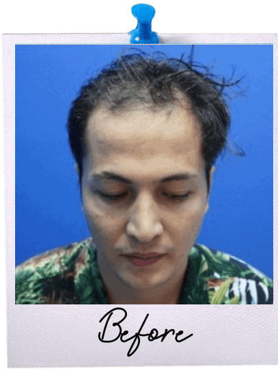 Hair Transplant centre malaysia - Before Hair Transplant image 112