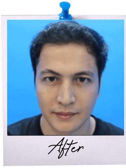 Hair Transplant centre malaysia - After Hair Transplant image 112