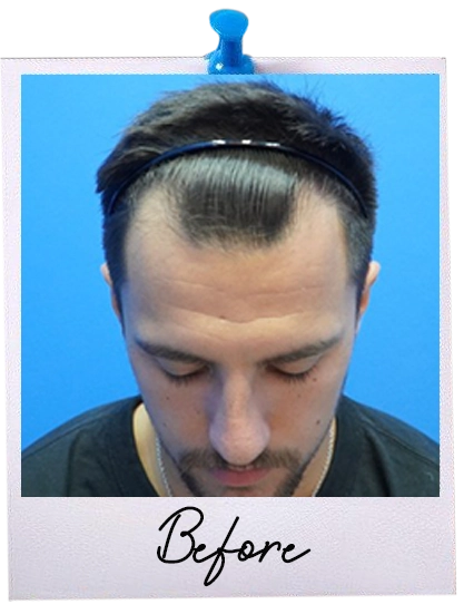 Hair Transplant centre malaysia - Before Hair Transplant image 120