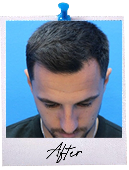 Hair Transplant centre malaysia - Before Hair Transplant image 120