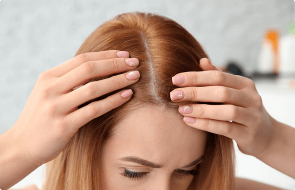 FUE-FEMALE-PATTERN-B