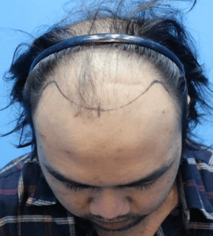 HT Before Picutre in Hair Transplant Center Malaysia