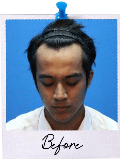 Hair Transplant centre malaysia - Aliff Aziz Before Hair Transplant image