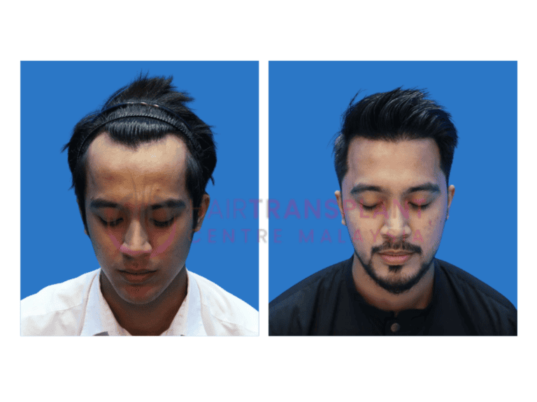 Hair Transplant centre malaysia - Aliff Aziz After Hair Transplant before after image