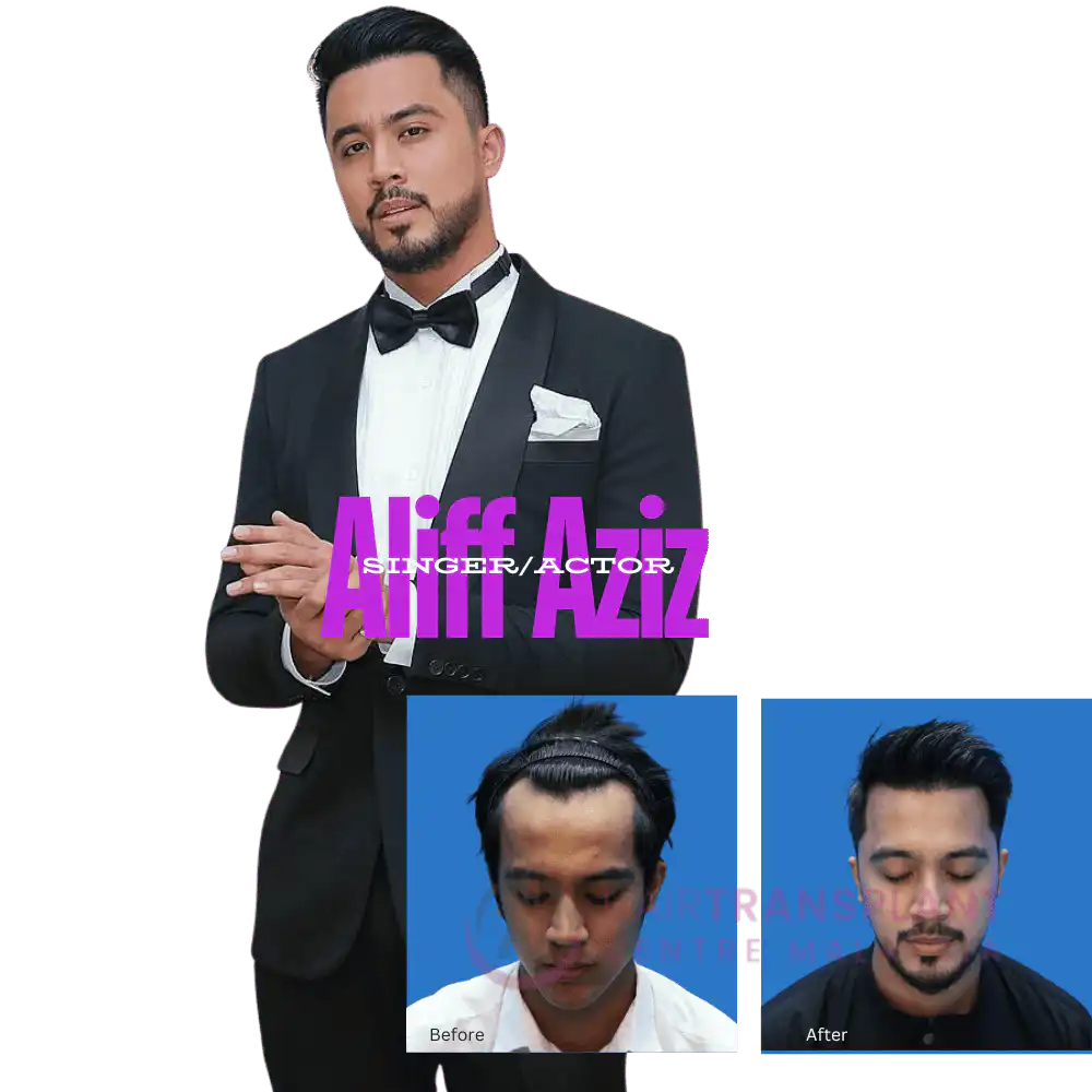Hair Transplant Centre Malaysia - Aliff Aziz (3)