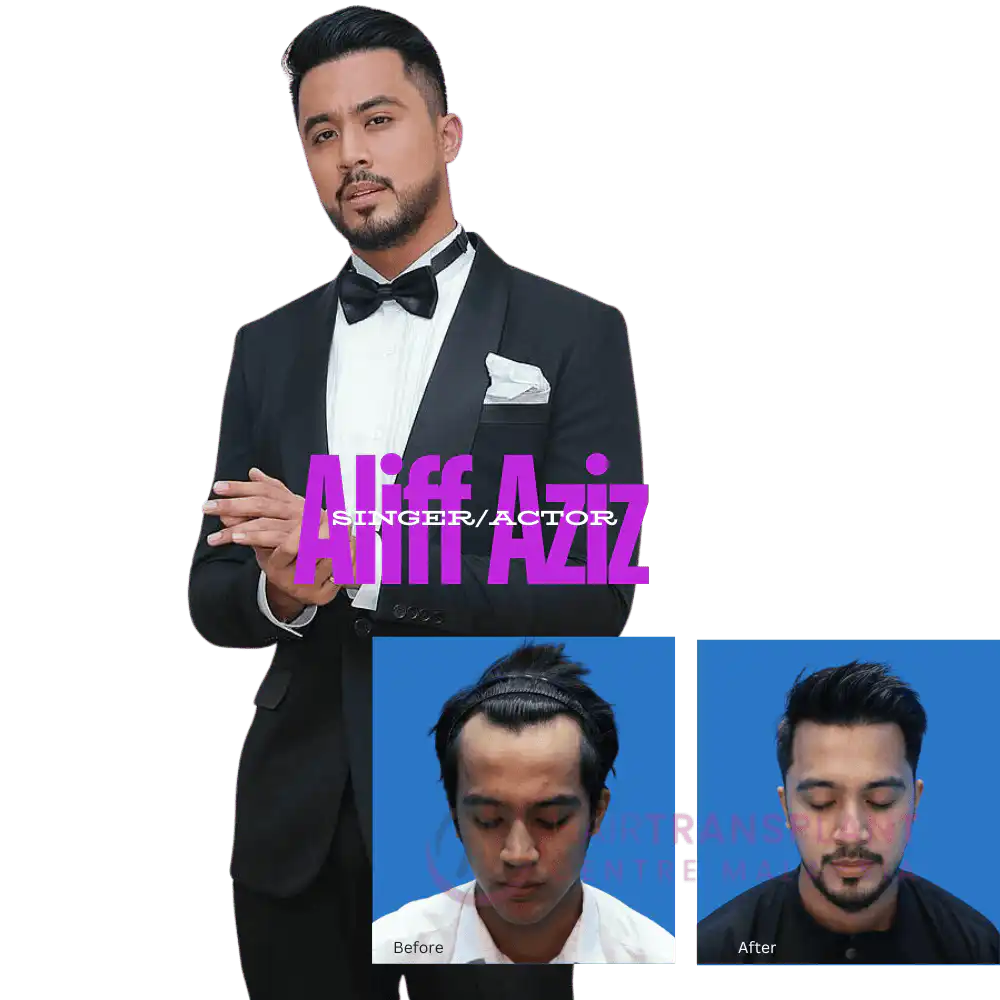 Hair Transplant Centre Malaysia - Hair Transplant - Aliff Aziz (Singer/Actor)