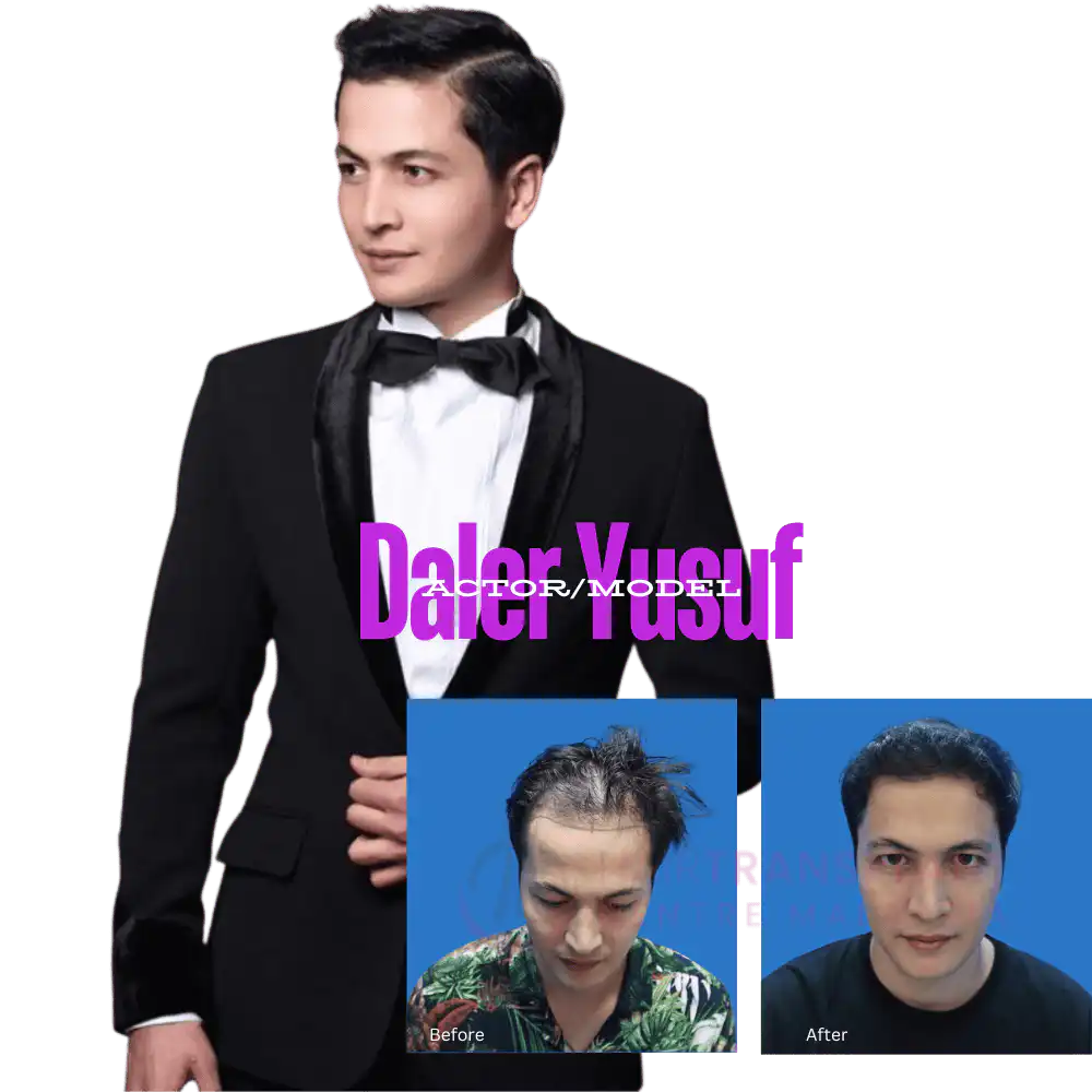 Hair Transplant Centre Malaysia - Hair Transplant - Aliff Aziz (Singer/Actor)