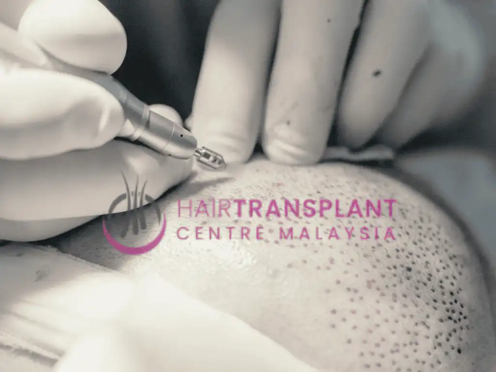 Hair Transplant Centre Malaysia - Recipient Site Creation