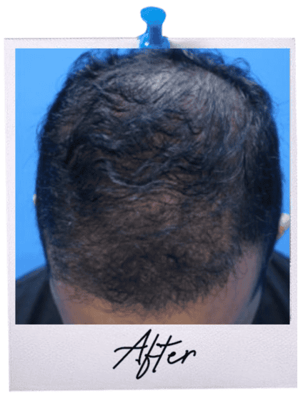 Hair Transplant Centre Malaysia - After image