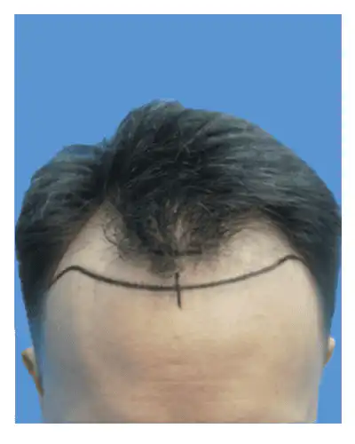 male pattern hair baldness 2025