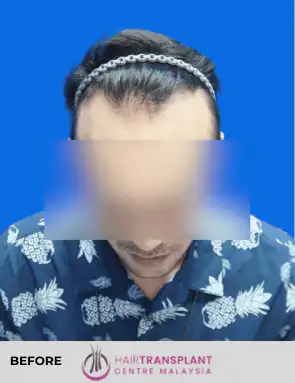 hair Transplant