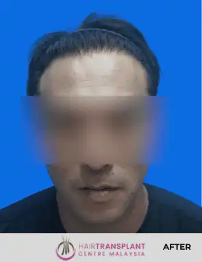 hair Transplant