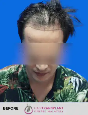 hair Transplant